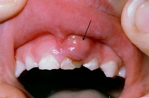 bệnh răng miệng,bệnh răng miệng ở trẻ em,bệnh răng miệng thường gặp,các bệnh răng miệng thường gặp,chữa bệnh răng miệng,nguyên nhân gây bệnh răng miệng,tình hình bệnh răng miệng ở việt nam,các bệnh răng miệng thường gặp ở trẻ,các bệnh răng miệng nguy hiểm,các bệnh răng miệng thường gặp ở trẻ em