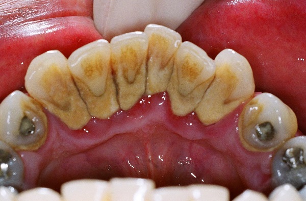 bệnh răng miệng,bệnh răng miệng ở trẻ em,bệnh răng miệng thường gặp,các bệnh răng miệng thường gặp,chữa bệnh răng miệng,nguyên nhân gây bệnh răng miệng,tình hình bệnh răng miệng ở việt nam,các bệnh răng miệng thường gặp ở trẻ,các bệnh răng miệng nguy hiểm,các bệnh răng miệng thường gặp ở trẻ em