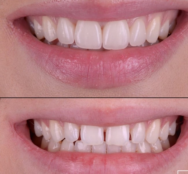 công nghệ phủ răng sứ invy ultra 3p
