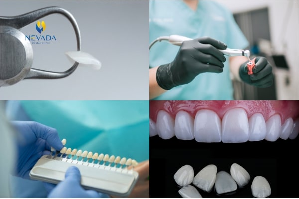 công nghệ phủ răng sứ invy ultra 3p