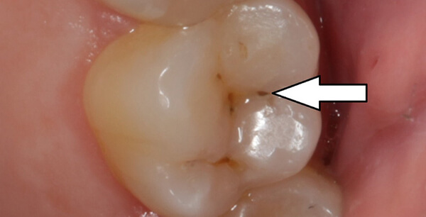 các mức độ sâu răng, các giai đoạn sâu răng, sâu răng giai đoạn đầu, sâu răng cấp độ, các cấp độ sâu răng, sâu răng độ 1, sâu răng cấp độ 1