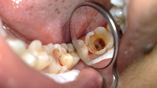 các mức độ sâu răng, các giai đoạn sâu răng, sâu răng giai đoạn đầu, sâu răng cấp độ, các cấp độ sâu răng, sâu răng độ 1, sâu răng cấp độ 1