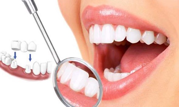khi nào nên bọc răng sứ, khi nào phải bọc răng sứ, khi nào thì nên bọc răng sứ, bọc răng sứ khi nào, nên bọc răng sứ khi nào, khi nào cần bọc răng sứ, khi nào thì bọc răng sứ