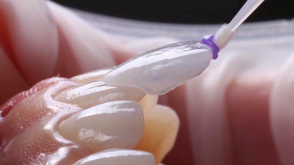 công nghệ phủ răng sứ invy ultra 3p, công nghệ phủ răng sứ invy ultra 3p giá bao nhiêu