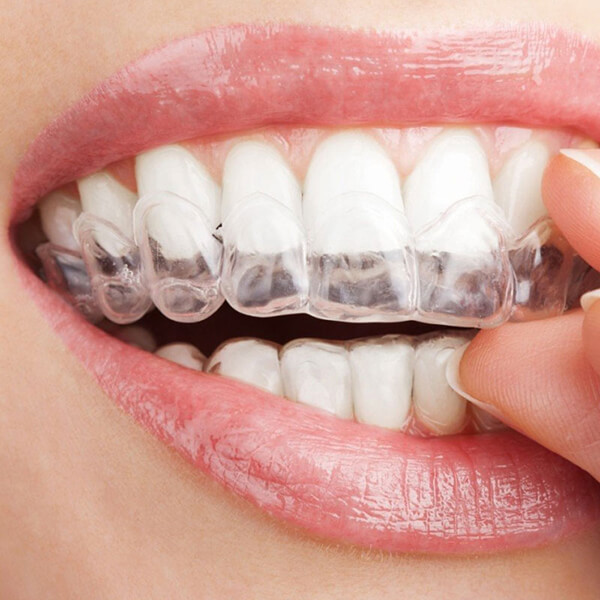 quy trình niềng răng như thế nào
