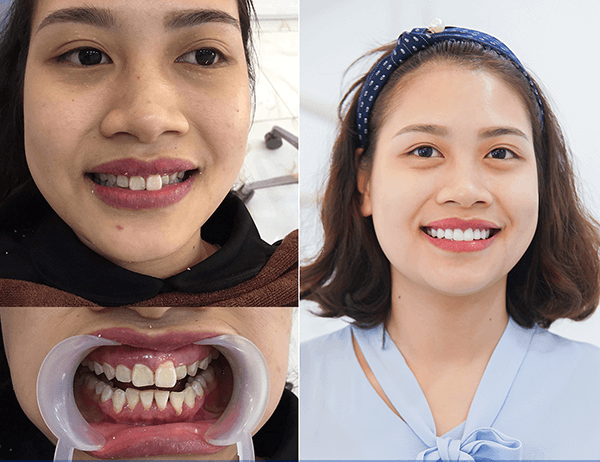 Răng hô bọc răng sứ có được không, răng hô bọc răng sứ có bền không, bọc sứ cho răng hô, bọc sứ răng hô, bọc răng sứ cho răng hô, răng hô có bọc sứ được không, răng hô bọc sứ, răng hô bọc răng sứ, bọc răng sứ bị hô, bọc sứ cho răng hô, bọc răng sứ chữa hô, bọc răng sứ chỉnh hô, bọc sứ răng cửa hô, bọc răng sứ cho răng hô giá bao nhiêu, bọc răng sứ giảm hô, bọc răng sứ hết hô, bọc răng sứ hàm hô, bọc răng sứ hơi hô, bọc răng sứ khi bị hô, bọc răng sứ trị hô, bọc răng sứ thẩm mỹ hô, bọc răng sứ vẫn bị hô