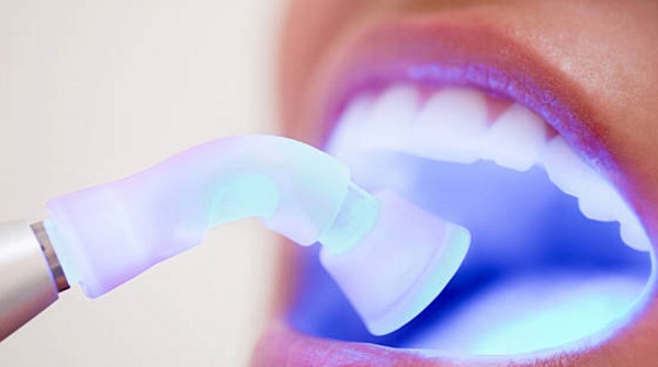tẩy trắng răng là gì, tẩy trắng răng là làm gì, tẩy trắng răng là như thế nào, tẩy trắng răng là gì, tẩy trắng răng là làm gì, tẩy trắng răng là j