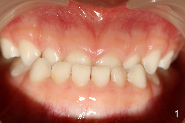 xem tướng răng quặp vào trong, con gái răng quặp, răng hàm dưới quặp vào trong, răng hàm trên quặp vào trong, tướng răng quặp vào trong, răng thụt vào trong tướng số, chỉnh hình răng quặp vào, răng quặp, răng quặp ki bo, răng cửa quặp vào trong, chữa răng quặp, răng quặp có ý nghĩa gì, răng quặp là gì, xem tướng răng quặp, răng quặp là như thế nào, người răng quặp, niềng răng quặp, răng quặp vào trong, tướng răng quặp, đàn ông răng quặp, phụ nữ răng quặp, răng cụp vào trong, răng quặp có niềng được không, răng quắp vào, răng cụp, răng bị cụp vào trong, răng bị quặp vào trong