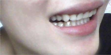 xem tướng răng quặp vào trong, con gái răng quặp, răng hàm dưới quặp vào trong, răng hàm trên quặp vào trong, tướng răng quặp vào trong, răng thụt vào trong tướng số, chỉnh hình răng quặp vào, răng quặp, răng quặp ki bo, răng cửa quặp vào trong, chữa răng quặp, răng quặp có ý nghĩa gì, răng quặp là gì, xem tướng răng quặp, răng quặp là như thế nào, người răng quặp, niềng răng quặp, răng quặp vào trong, tướng răng quặp, đàn ông răng quặp, phụ nữ răng quặp, răng cụp vào trong, răng quặp có niềng được không, răng quắp vào, răng cụp, răng bị cụp vào trong, răng bị quặp vào trong