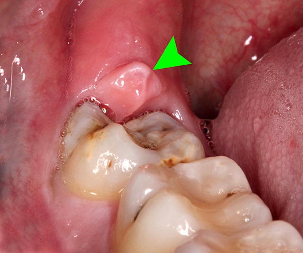 bị sưng nướu răng trong cùng hàm dưới, nóng sưng nướu răng trong cùng hàm dưới, đau nướu răng hàm dưới, sưng nướu trong cùng hàm dưới, bị sưng nướu răng hàm dưới, sưng lợi hàm dưới trong cùng, viêm nướu răng hàm dưới, sưng lợi trong cùng hàm dưới, sưng nướu răng hàm dưới, sưng nướu răng trong cùng hàm dưới, sưng lợi răng hàm dưới, sưng chân răng hàm dưới
