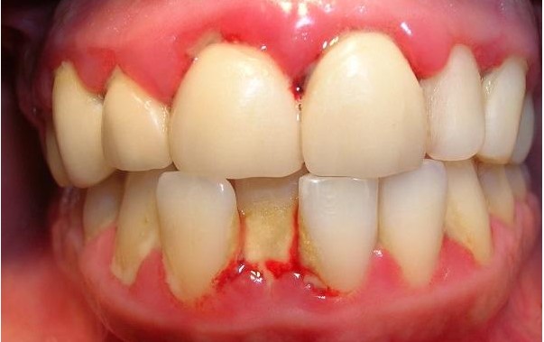bị viêm lợi khi làm răng sứ, bị viêm lợi sau khi bọc răng sứ, bọc răng sứ bị viêm lợi, bọc răng sứ bị viêm lợi webtretho, bọc răng sứ bị viêm nướu, làm răng sứ xong bị viêm lợi, răng sứ bị viêm lợi, viêm lợi khi bọc răng sứ, viêm lợi khi làm răng sứ, viêm lợi sau khi bọc răng sứ, viêm nướu khi bọc răng sứ