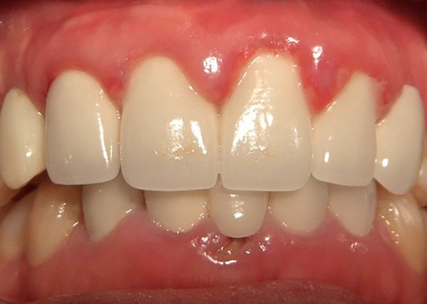 cách trị tụt nướu răng tại nhà, cách chữa tụt lợi tại nhà