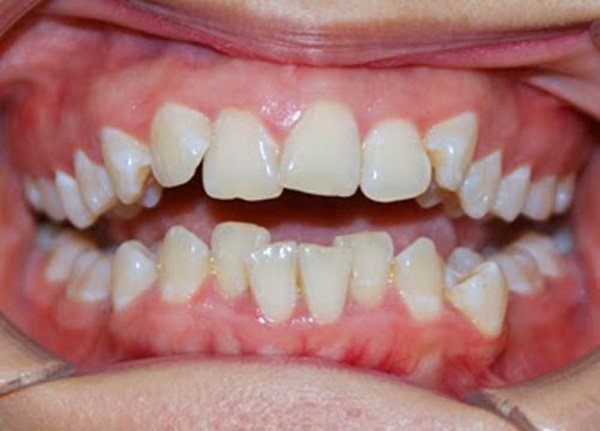 răng lệch lạc nên niềng hay bọc sứ, niềng răng lệch lạc, niềng răng lệch lạc là gì, sửa răng lệch, răng lệch lạc chữa thế nào, niềng răng lệch lạc mất bao lâu, giá chỉnh răng lệch lạc