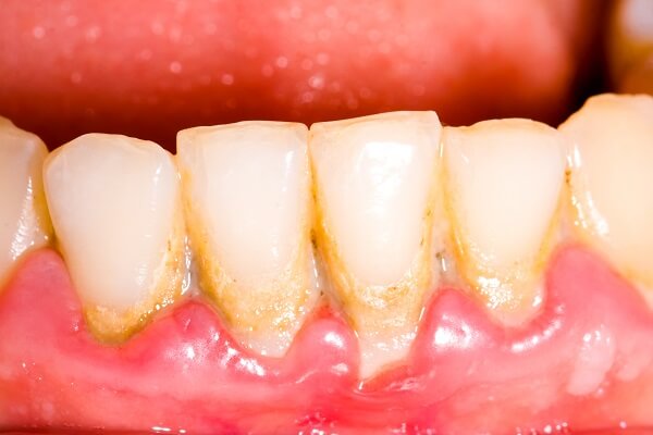 có nên lấy cao răng không,có nên lấy cao răng thường xuyên không,có nên đi lấy cao răng không,có nên lấy cao răng
