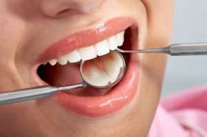 có nên lấy cao răng không,có nên lấy cao răng thường xuyên không,có nên đi lấy cao răng không,có nên lấy cao răng