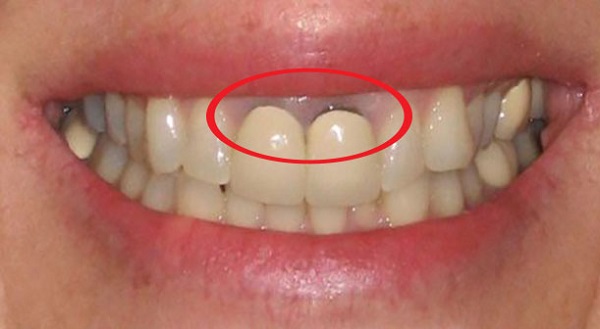 Dị ứng với răng sứ kim loại, bị dị ứng với răng sứ kim loại, phải làm sao khi bị dị ứng với răng sứ kim loại, dị ứng răng sứ kim loại, dị ứng với răng sứ kim loại phải làm sao