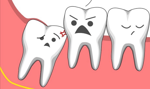 nhổ răng khôn có nguy hiểm không, nhổ răng khôn hàm trên có nguy hiểm không, nhổ răng khôn có nguy hiểm k, nhổ răng khôn có nguy hiểm ko