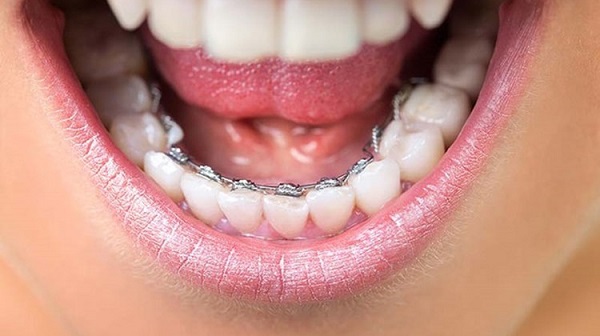 các loại niềng răng mắc cài sứ, các loại niềng răng mắc cài, các loại niềng răng không mắc cài, các loại mắc cài khi niềng răng, giá các loại mắc cài niềng răng