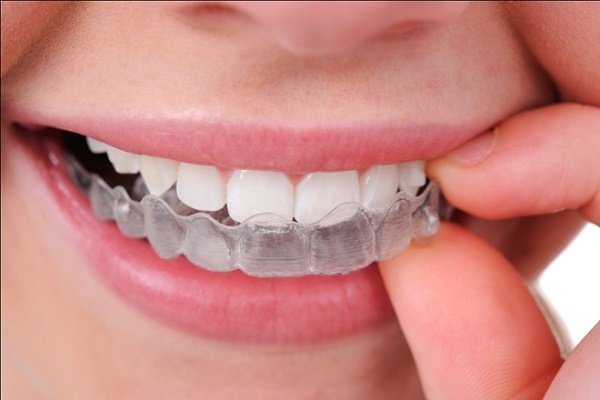 niềng răng có phải nhổ răng không, niềng răng invisalign có nhổ răng không, niềng răng có phải nhổ răng khôn không, niềng răng không nhổ, niềng răng phải nhổ răng, niềng răng không cần nhổ răng, niềng răng hô có cần nhổ răng không, niềng răng có nhổ răng không, niềng răng không nhổ răng, niềng răng trong suốt có cần nhổ răng không