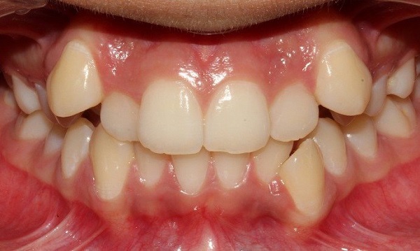 lệch đường giữa răng, chỉnh răng lệch đường giữa, niềng răng lệch đường giữa, niềng răng bị lệch đường giữa, răng bị lệch nhân chung, răng bị lệch nhân trung, niềng răng bị lệch nhân trung, răng lệch nhân trung, lệch nhân trung, răng bị lệch đường giữa, răng lệch đường giữa, răng cửa lệch nhân trung, niềng răng xong bị lệch nhân trung, lệch nhân trung là gì, nhân trung bị lệch