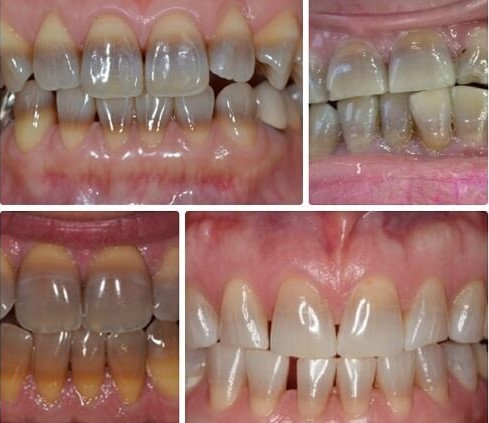 răng nhiễm màu kháng sinh, răng bị nhiễm màu kháng sinh, răng bị nhiễm màu kháng sinh có tẩy trắng được không, răng nhiễm kháng sinh, răng nhiễm kháng sinh là gì, răng nhiễm kháng sinh có tẩy được không, tẩy trắng răng nhiễm kháng sinh, răng bị nhiễm kháng sinh, răng bị nhiễm màu kháng sinh