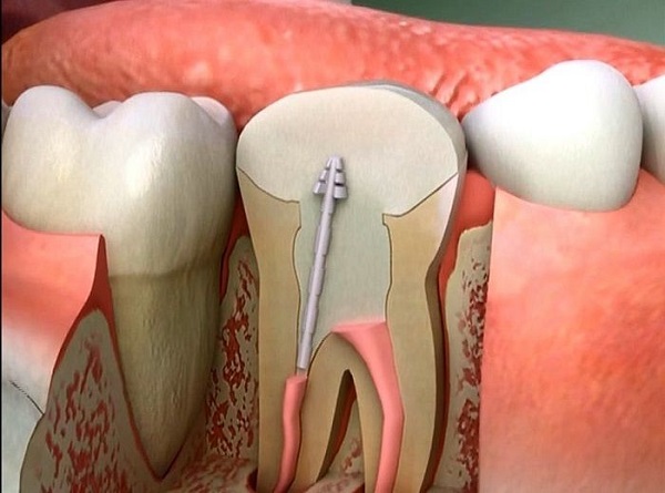 răng đã lấy tủy tồn tại được bao lâu, răng đã lấy tủy tuổi thọ được bao lâu