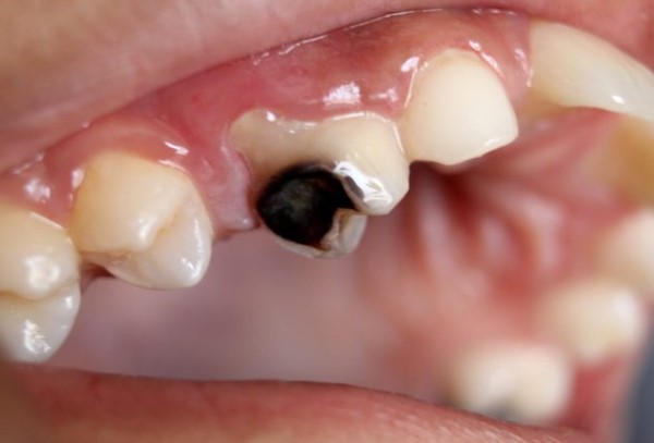 nhức răng hàm trên, đau nhức răng hàm trên, nhức răng cửa, nhức răng không ngủ được