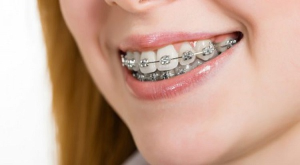 niềng răng hô móm, niềng răng hô móm lệch lạc, niềng răng hô móm có đau không, quá trình niềng răng hô, quy trình niềng răng hô, 