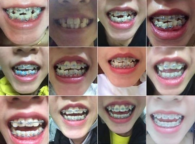 niềng răng đẹp hơn, niềng răng có đẹp hơn không, niềng răng xong có đẹp hơn không