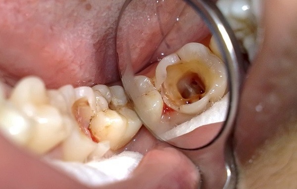 Cách chữa sâu răng hàm