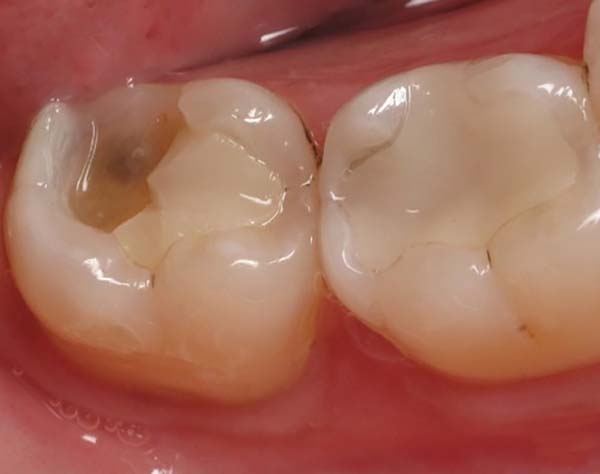 đau nhức răng hàm dưới, đau răng hàm dưới, nhức răng hàm dưới, nhức răng hàm dưới bên trái, bị nhức răng hàm dưới, đau răng hàm dưới bên phải, bị đau răng hàm dưới, đau răng hàm dưới trong cùng, nhức chân răng hàm dưới, đau răng cấm hàm dưới, nhức răng trong cùng hàm dưới, đau răng trong cùng hàm dưới, nhức răng hàm dưới bên phải