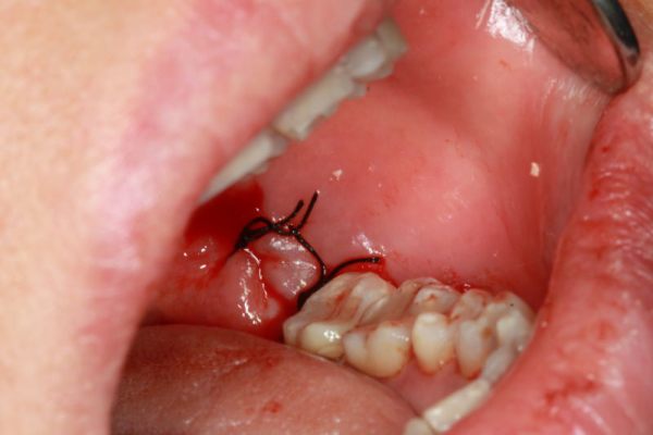 lỗ hổng sau khi nhổ răng, nhổ răng khôn để lại lỗ, nhổ răng để lại lỗ, lỗ sau khi nhổ răng khôn