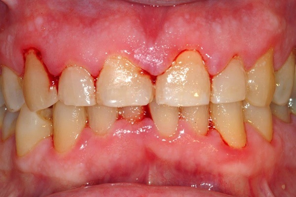 lở nướu răng, bị lở nướu răng, bị lỡ nướu răng, cách trị lở nướu răng, nú răng bị lở