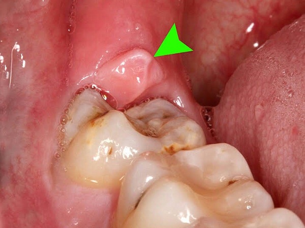 lở nướu răng, bị lở nướu răng, bị lỡ nướu răng, cách trị lở nướu răng, nú răng bị lở