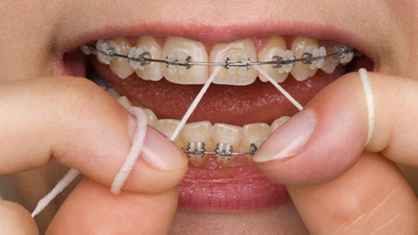 Niềng răng có đau không, Niềng răng giai đoạn nào đau nhất, niềng răng đau không, niềng răng đau nhất giai đoạn nào, niềng răng bị đau, niềng răng hô có đau không, nẹp răng có đau không