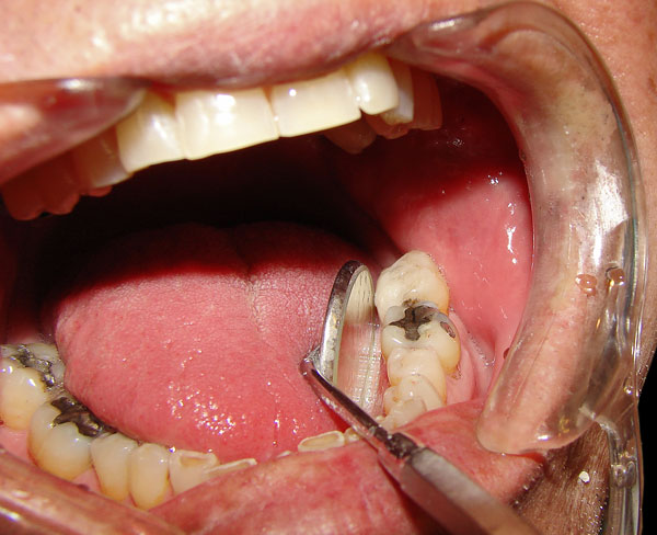 nhổ răng số 4 để niềng răng, niềng răng phải nhổ răng số 4, niềng răng nhổ răng số 4, niềng răng nhổ răng số 4 có ảnh hưởng gì không, nhổ răng số 4 khi niềng răng