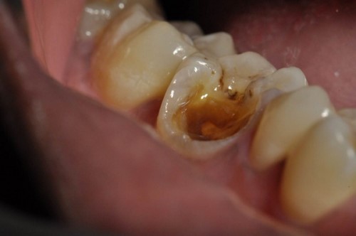 nguyên nhân sâu răng hàm dưới, sâu răng hàm dưới trong cùng, sâu răng hàm dưới nặng, sâu răng hàm dưới nên làm gì, sâu răng hàm dưới, bị sâu răng hàm dưới, bị sâu răng hàm dưới nên làm gì, nhổ răng sâu hàm dưới