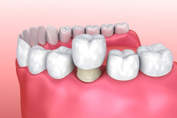 bọc sứ răng hàm