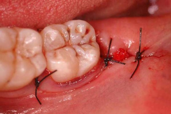 cục máu đông sau nhổ răng, cục máu đông sau khi nhổ răng, cục máu đông sau khi nhổ răng khôn, máu đông sau khi nhổ răng