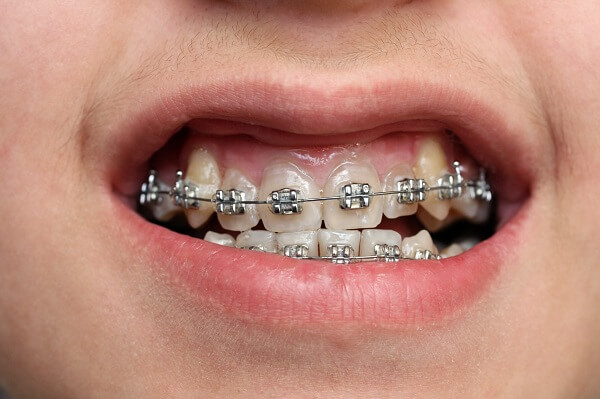 răng hàm dưới chìa ra ngoài, tại sao răng hàm dưới chìa ra ngoài, Nguyên nhân hàm răng dưới chìa ra ngoài, Cách chữa hàm răng dưới chìa ra ngoài, hàm răng dưới nhô ra, răng hàm dưới đưa ra, kéo cụm răng cửa là gì, hàm dưới nhô ra, hàm răng dưới, vẩu hàm dưới, răng chìa ra