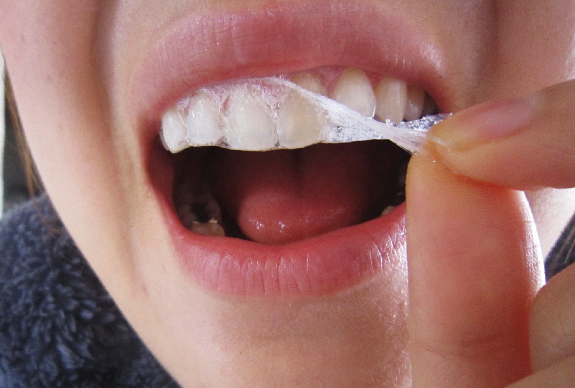 lưu ý tẩy trắng răng, lưu ý khi tẩy trắng răng, lưu ý sau khi tẩy trắng răng, lưu ý khi tẩy trắng răng tại nhà, những lưu ý khi tẩy trắng răng, những lưu ý khi tẩy trắng răng tại nhà, lưu ý trước khi tẩy trắng răng, tẩy trắng răng, giá tẩy trắng răng, có nên tẩy trắng răng, cách tẩy trắng răng tại nhà, những điều cần lưu ý sau khi tẩy trắng răng, lưu ý khi đi tẩy trắng răng, các lưu ý khi tẩy trắng răng, cần lưu ý khi tẩy trắng răng 