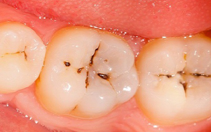 răng bị chết tủy phải làm sao, răng bị chết tủy,tủy răng bị chết, răng chết tủy phải làm sao, dấu hiệu răng bị chết tủy, cách chữa răng bị chết tủy, xử lý răng chết tủy, răng chết tủy có nên nhổ, răng chết tủy tồn tại được bao lâu, răng chết tủy thì sao, nhổ răng chết tủy có đau không, làm chết răng tủy, làm sao để biết tủy răng chết, răng chết tủy