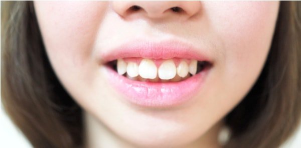 Răng hàm dưới thụt vào trong là gì, Tác hại khi răng hàm dưới thụt vào trong, khắc phục răng hàm dưới thụt vào trong, hàm dưới thụt vào, răng thụt vào trong, răng bị thụt vào trong, hàm dưới bị thụt vào