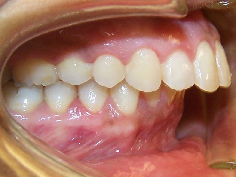 Răng hàm dưới thụt vào trong là gì, Tác hại khi răng hàm dưới thụt vào trong, khắc phục răng hàm dưới thụt vào trong, hàm dưới thụt vào, răng thụt vào trong, răng bị thụt vào trong, hàm dưới bị thụt vào