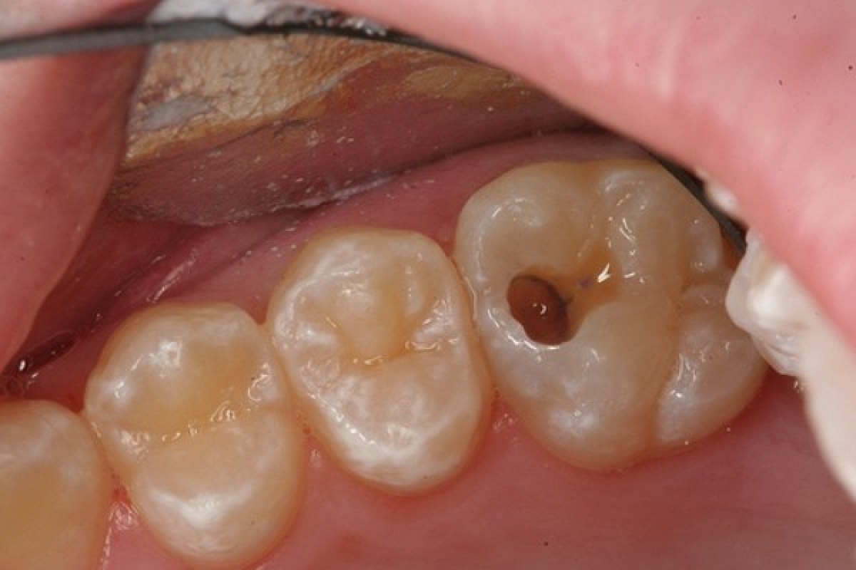 Sâu răng có niềng được không, răng sâu có niềng răng được không, răng bị sâu có niềng được không, bị sâu răng có niềng răng được không