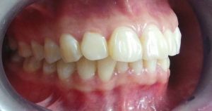 tại sao răng càng ngày càng hô, răng càng ngày càng hô, hô răng, răng bị hô phải làm sao, cách làm răng hết hô tại nhà, răng hô phải làm sao, cách làm răng hết hô, niềng răng có hết hô không , làm sao để răng hết hô, cách làm cho răng hết hô