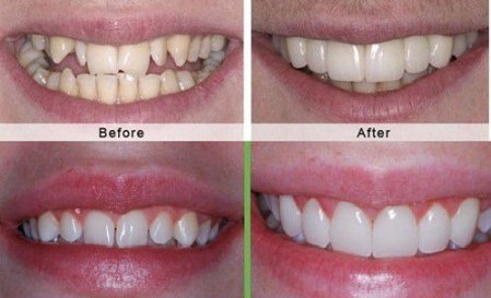 bọc răng sứ nguyên hàm bao nhiêu tiền, bọc răng sứ nguyên hàm giá bao nhiêu, chi phí bọc răng sứ nguyên hàm, giá bọc răng sứ nguyên hàm, giá làm răng sứ nguyên hàm, giá răng sứ nguyên hàm