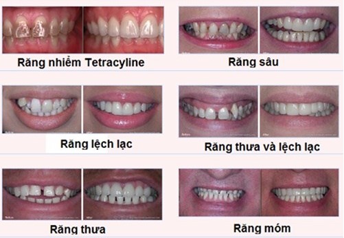 bọc răng sứ nguyên hàm bao nhiêu tiền, bọc răng sứ nguyên hàm giá bao nhiêu, chi phí bọc răng sứ nguyên hàm, giá bọc răng sứ nguyên hàm, giá làm răng sứ nguyên hàm, giá răng sứ nguyên hàm