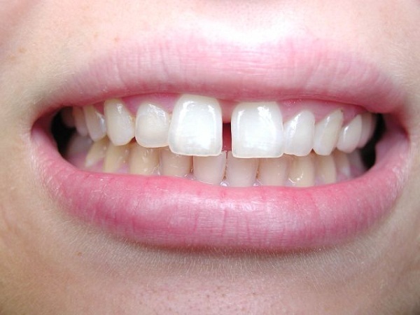có nên bọc sứ răng cửa không, có nên bọc sứ răng cửa, có nên bọc răng sứ cho răng cửa không, bọc sứ răng cửa, bọc răng sứ cho răng cửa thưa, bọc răng sứ cho răng cửa