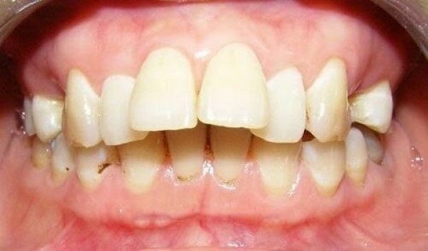 có nên bọc sứ răng cửa không, có nên bọc sứ răng cửa, có nên bọc răng sứ cho răng cửa không, bọc sứ răng cửa, bọc răng sứ cho răng cửa thưa, bọc răng sứ cho răng cửa
